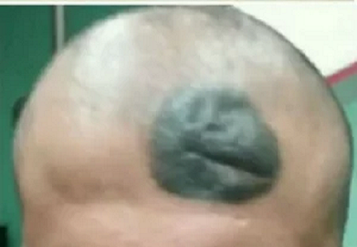 خال روی سر
