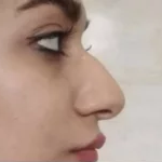 رینوپلاستی قبل