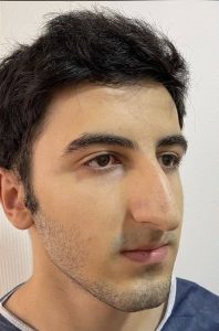 عمل رینوپلاستی قبل