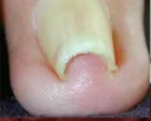 ناخن فرو رفته در گوشت