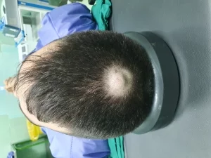 کیست مویی