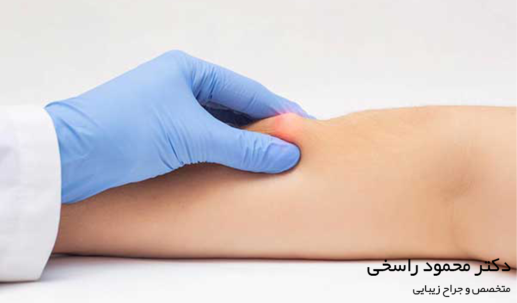 علائم لیپوم بدخیم و تفاوت آن با غده سرطانی