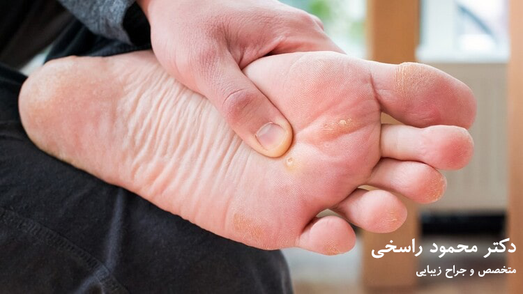 درمان میخچه کف پا